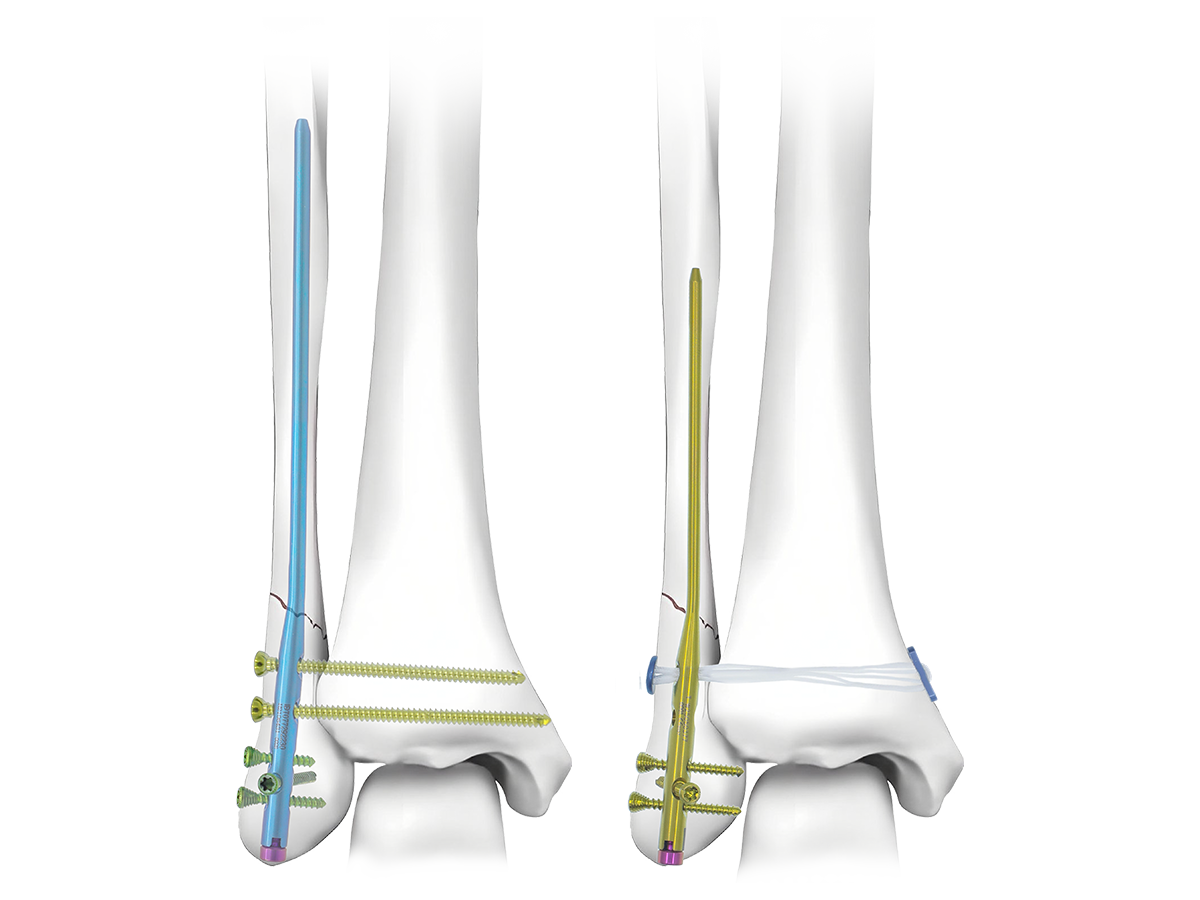 FYRO™ Expert Peroneal Clavo sistema de implante
