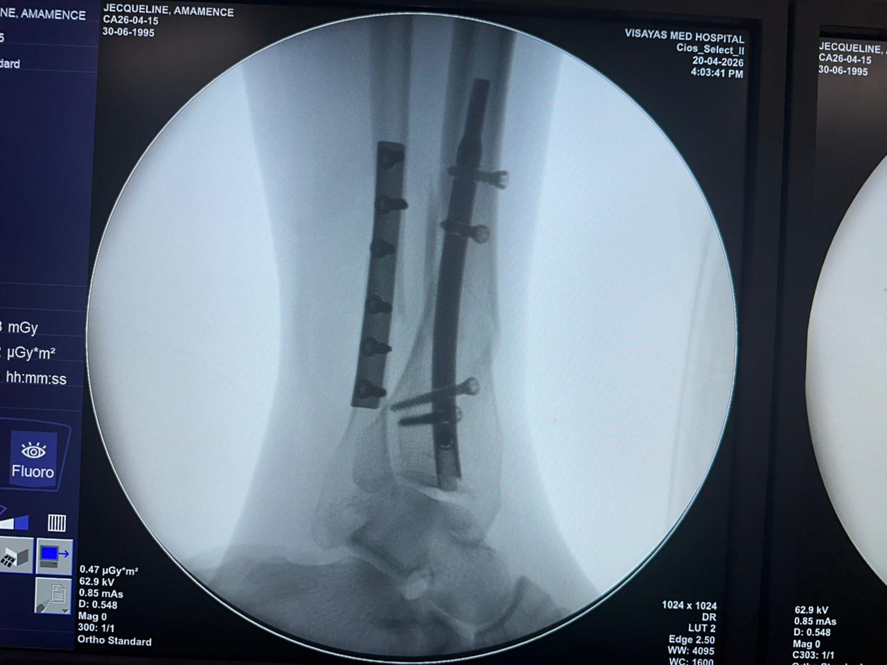 clavo-tibial-distal-fluoroscopia-intraoperatoria-CZMEDITECH