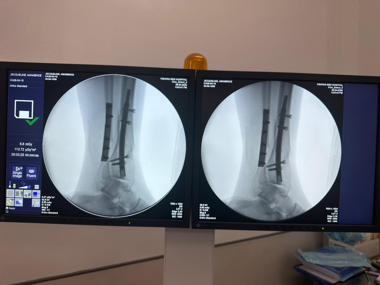 caso-de-clavo-tibial-distal-paciente-de-31-a&ntilde;os-ap-view-czmeditech
