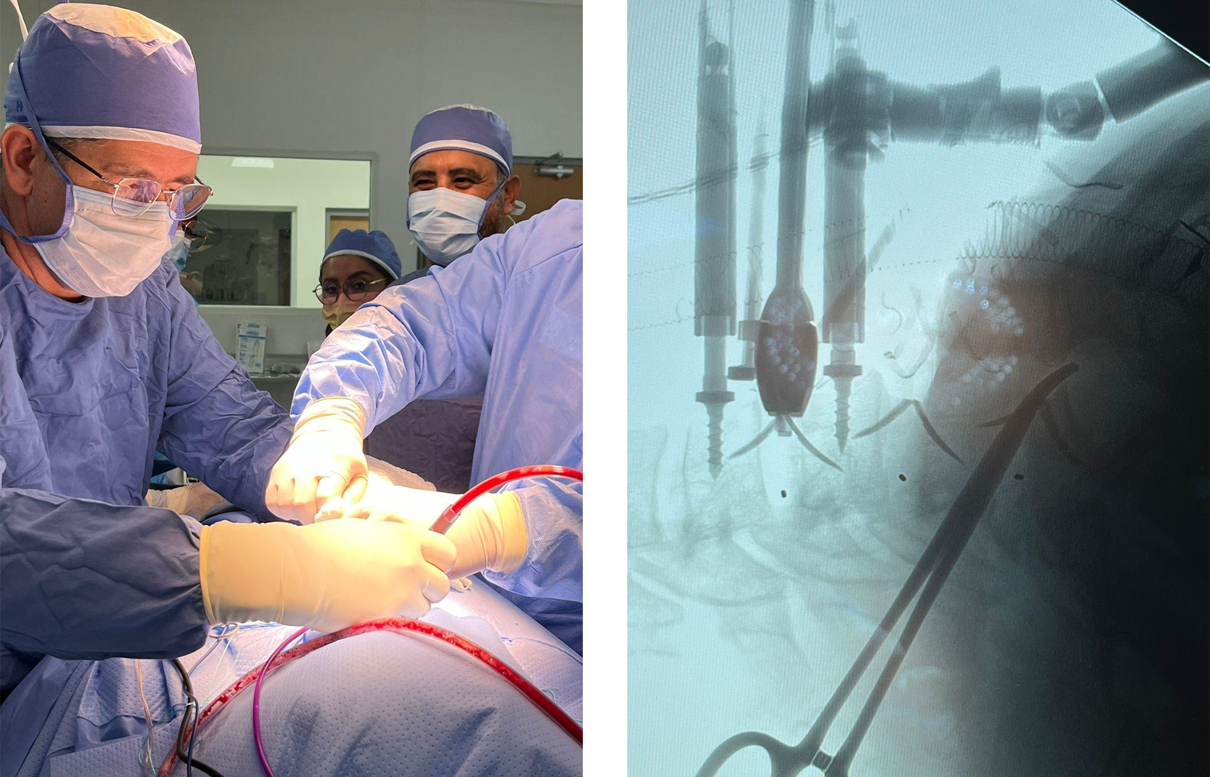 Im&aacute;genes preoperatorias de hernia de disco cervical y procedimiento de cirug&iacute;a de jaula Uni-C
