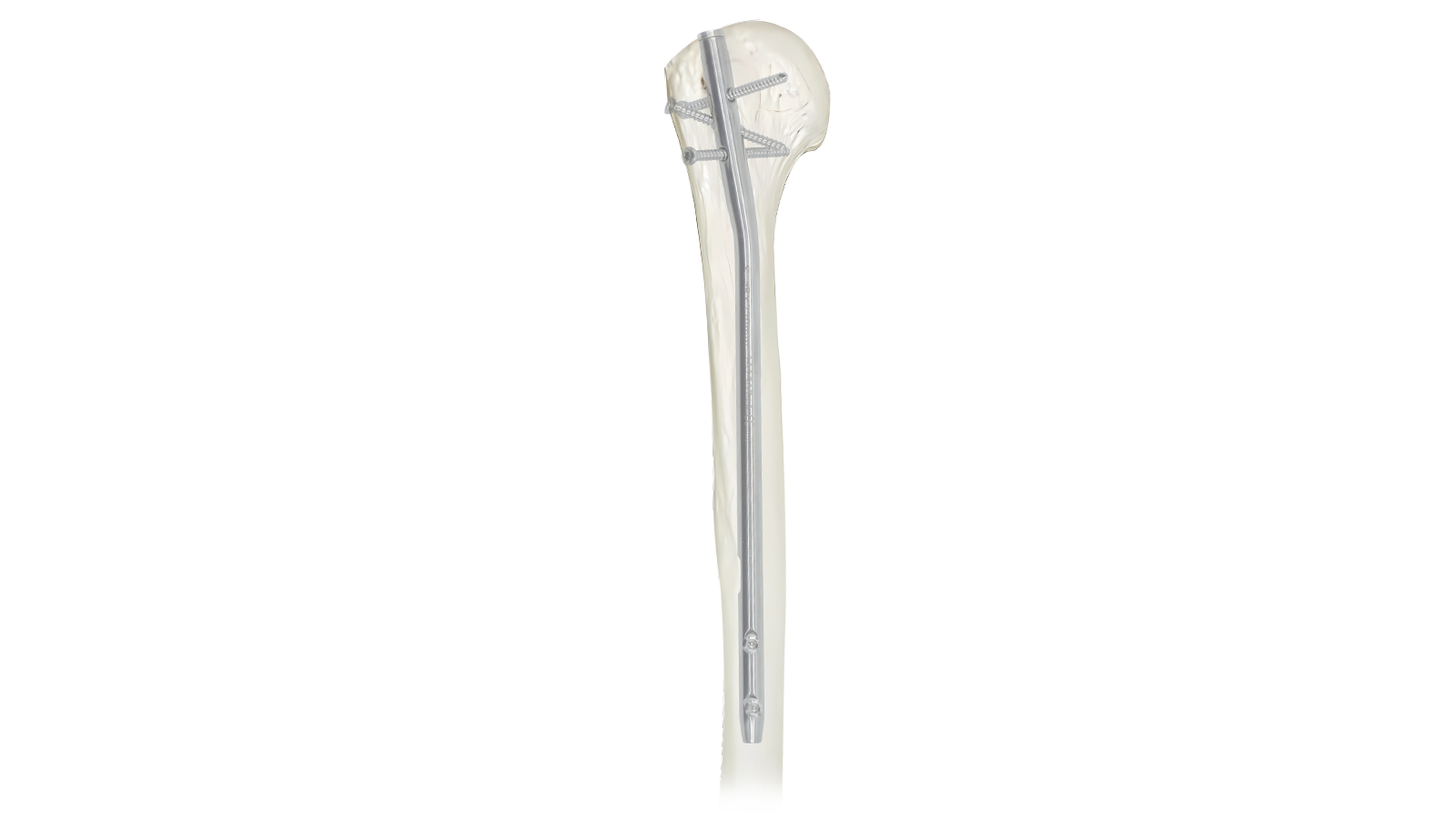 Clavo intramedular humeral ARVO™