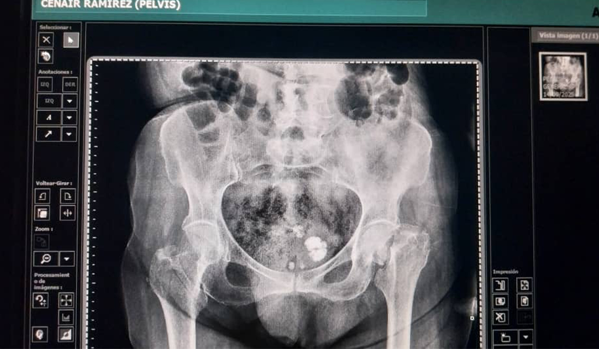 Radiograf&iacute;a preoperatoria que muestra una fractura de cadera izquierda. 