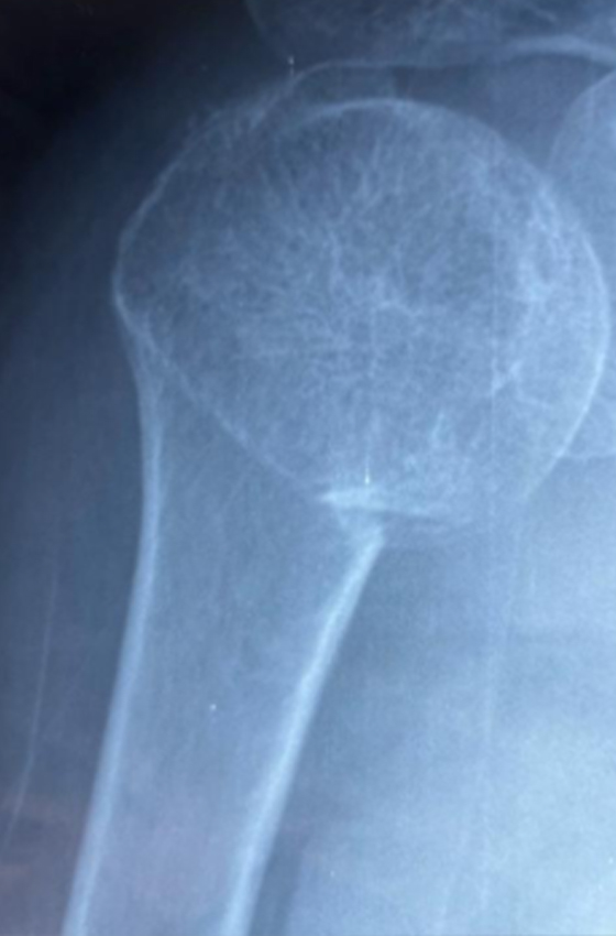 Radiograf&iacute;a posoperatoria del h&uacute;mero proximal