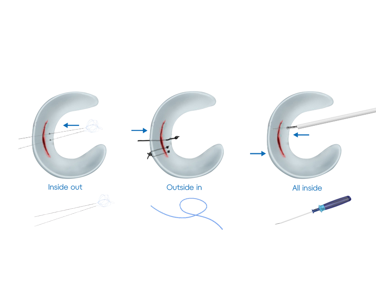 CZMEDITECH Sistema de reparación meniscal