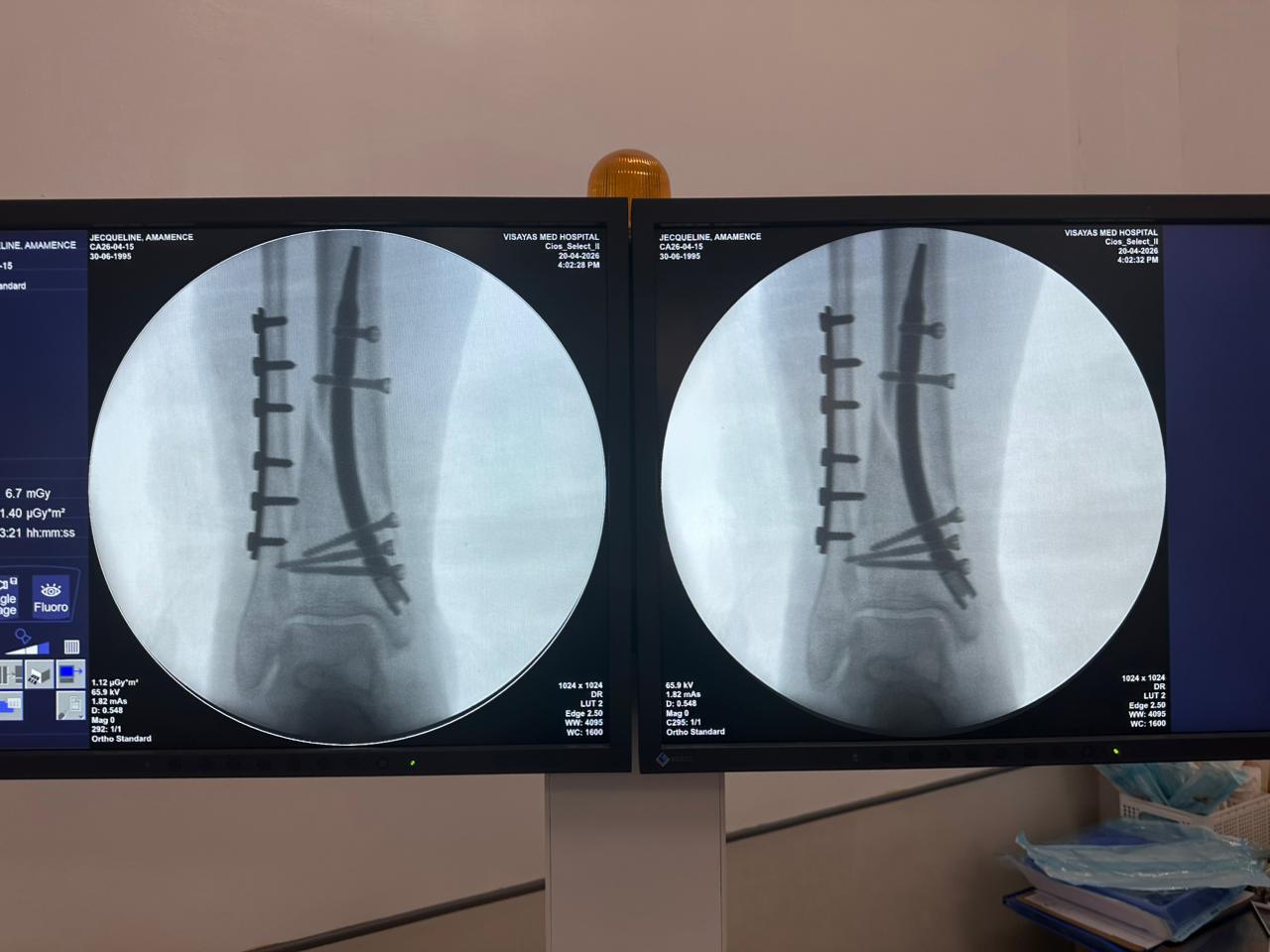 clavo-distal-tibial-caso-paciente-de-31-a&ntilde;os-vista-lateral-czmeditech
