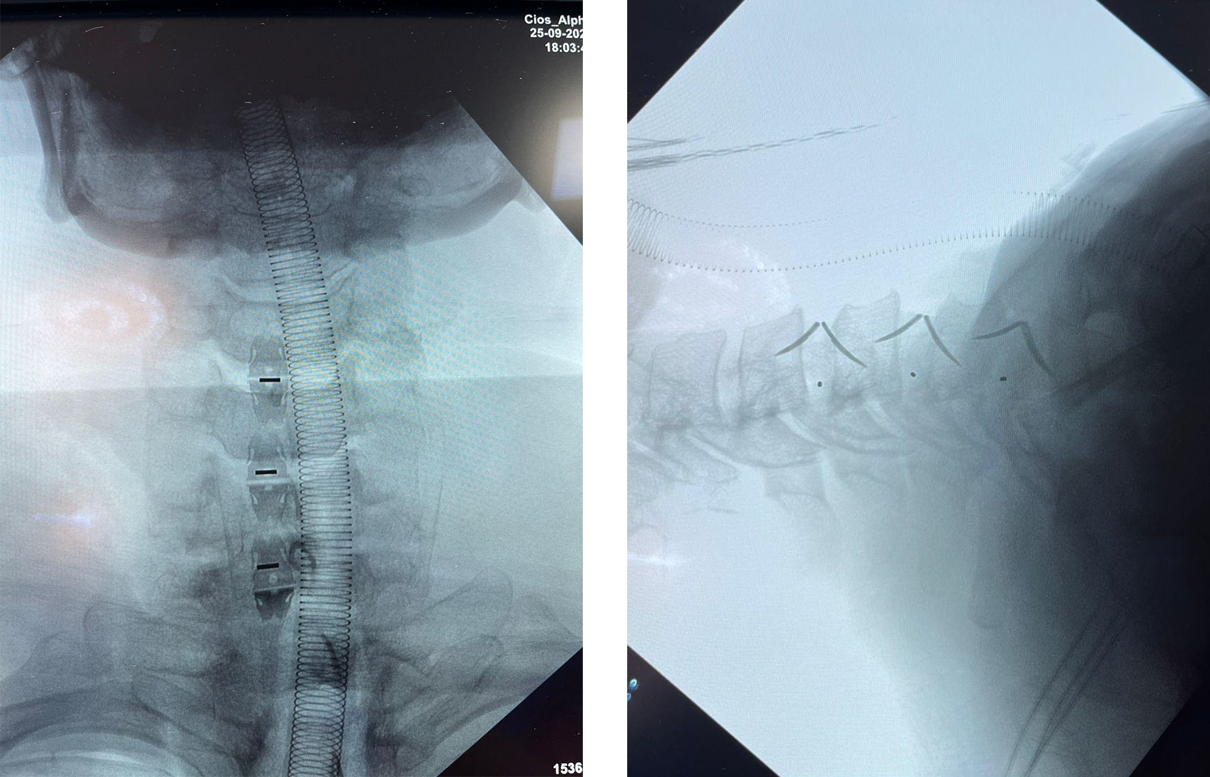 Radiograf&iacute;a cervical posoperatoria despu&eacute;s de una exitosa cirug&iacute;a de jaula cervical independiente Uni-C