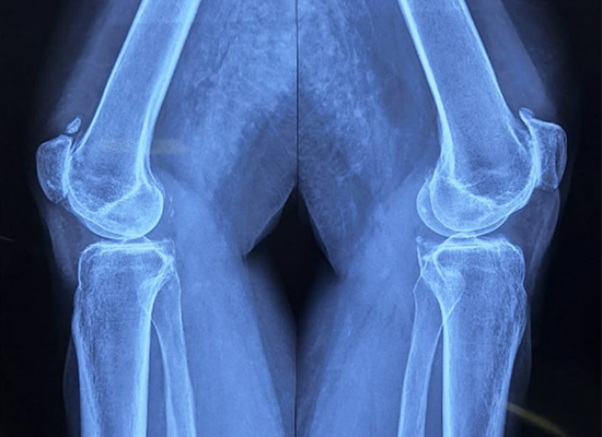 tkr-preoperatoria-radiografia-rodilla-izquierda