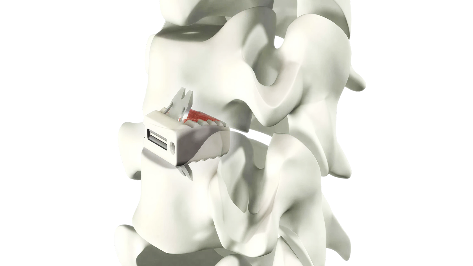 Uni-C™ Sistema de fusión intersomática cervical autónomo de PEEK