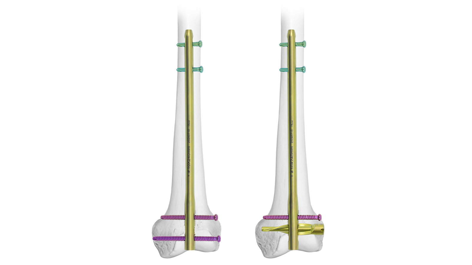 Clavo intramedular femoral distal VEXA™