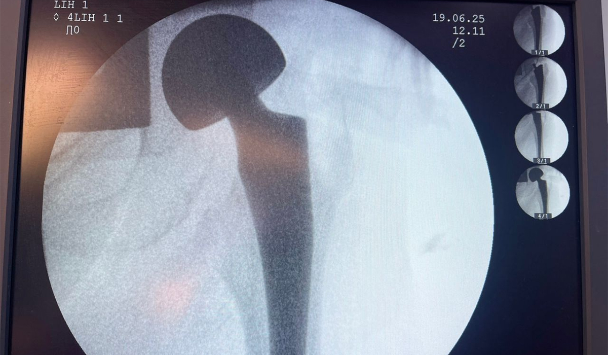 Radiograf&iacute;a postoperatoria que muestra una pr&oacute;tesis de cadera bipolar con buena posici&oacute;n y estabilidad.