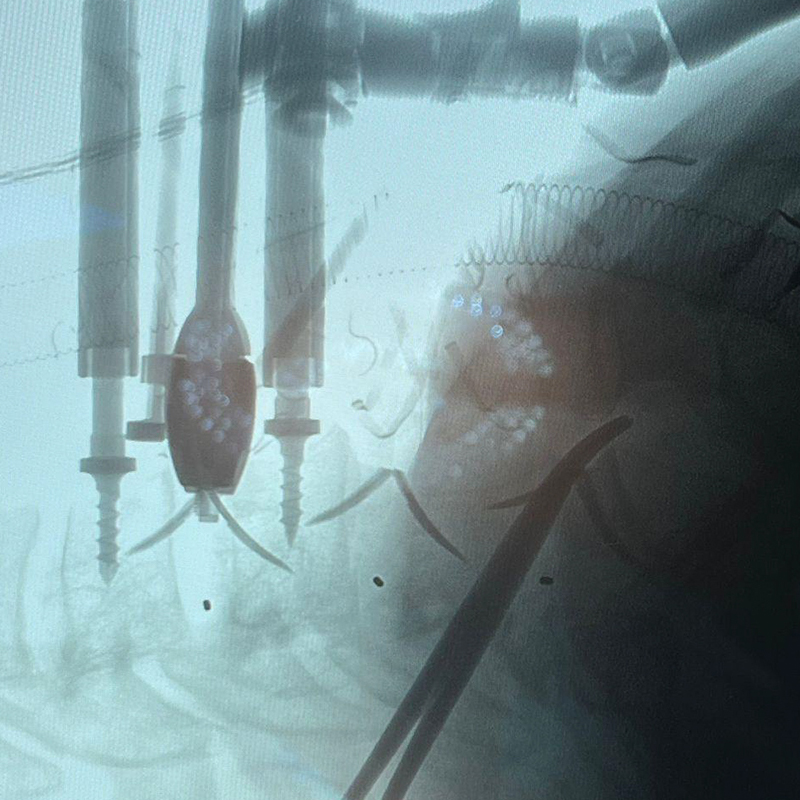Fluoroscopia de fusi&oacute;n cervical intraoperatoria