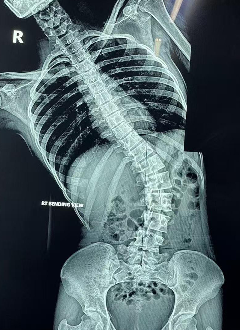 Radiograf&iacute;a AP preoperatoria 
