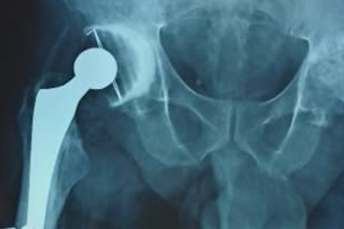 Radiograf&iacute;a de seguimiento a los dos meses de la artroplastia total de cadera derecha