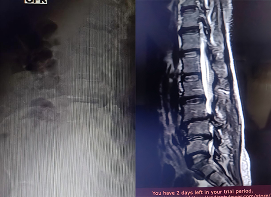 Radiograf&iacute;a preoperatoria de estenosis de columna lumbar