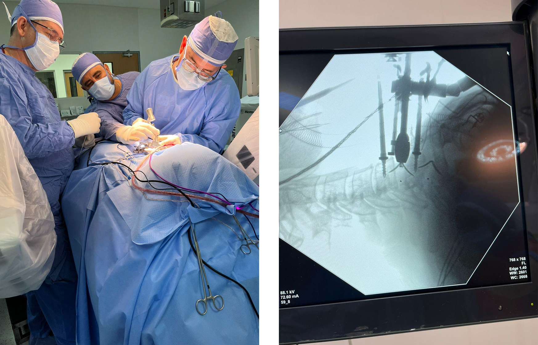 Im&aacute;genes preoperatorias de hernia de disco cervical y procedimiento de cirug&iacute;a de jaula Uni-C
