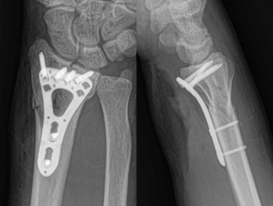 Radiograf&iacute;as posoperatorias de mu&ntilde;eca