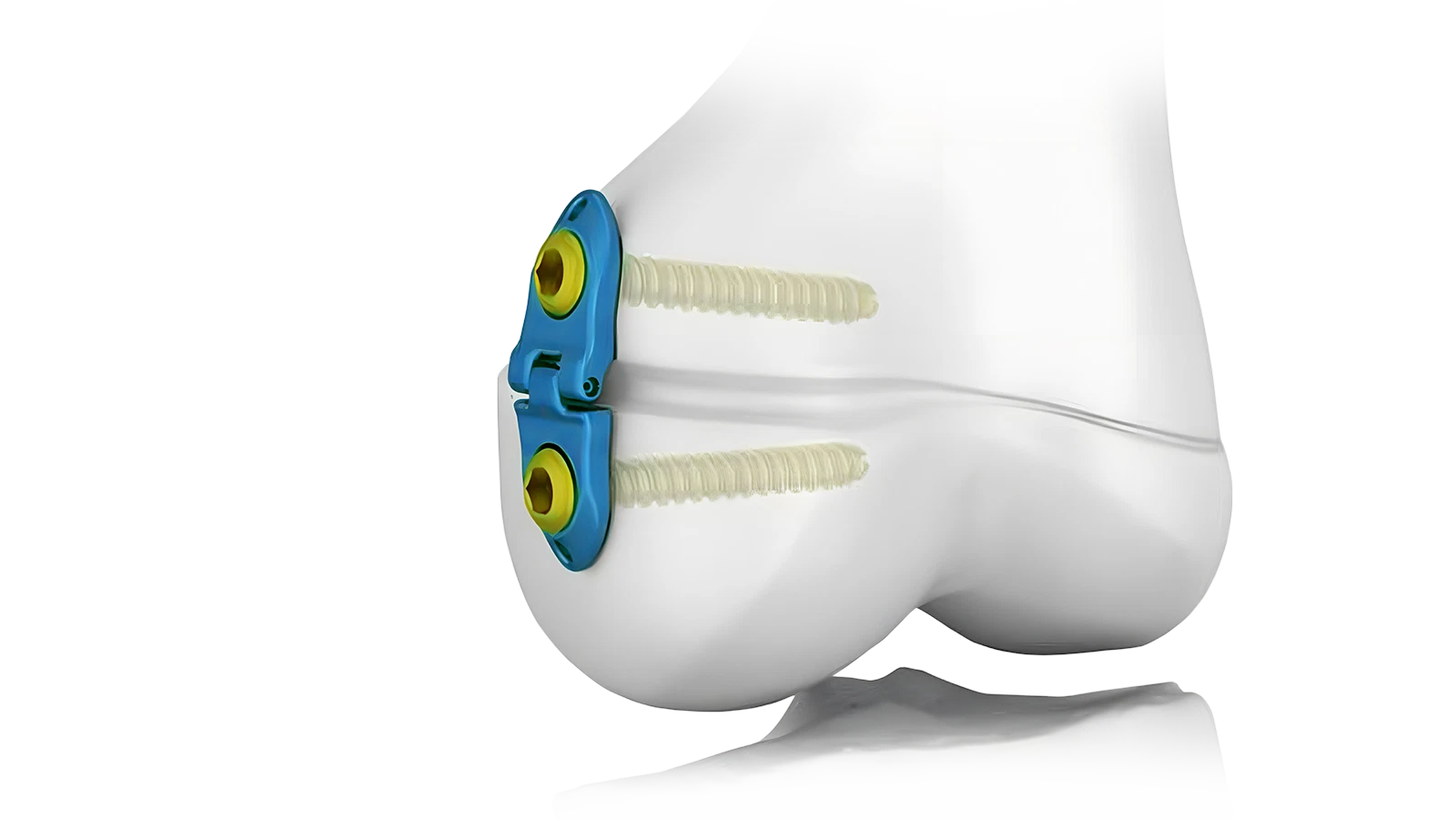 Pediatric locking plate system