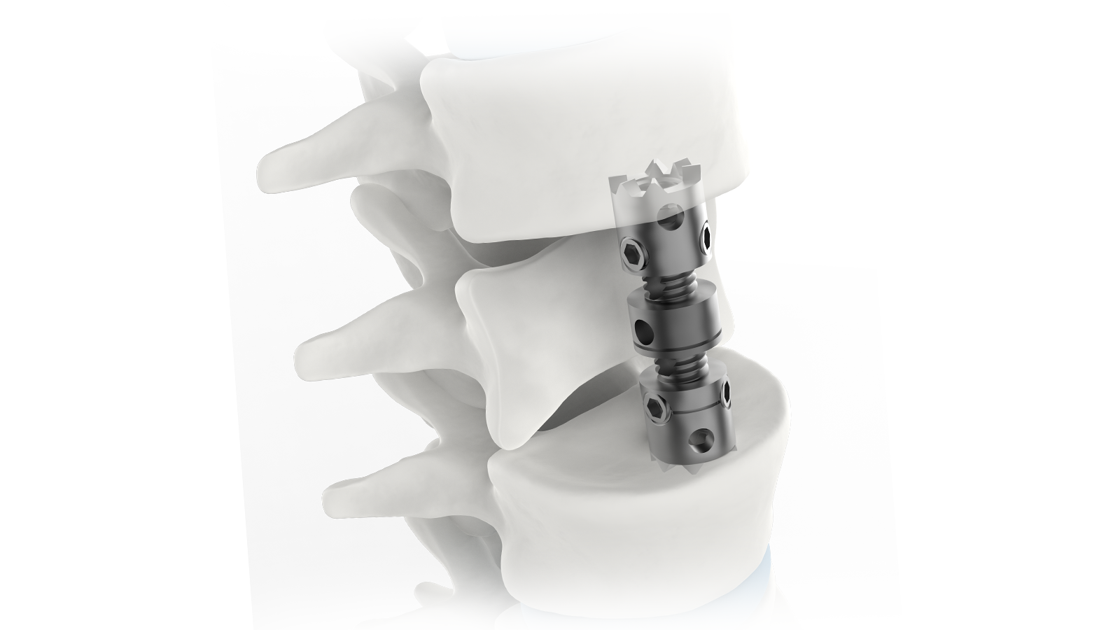 VERTA-X™ Sistema expandible de reemplazo del cuerpo vertebral