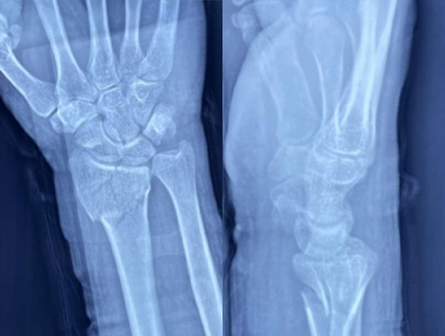 Radiograf&iacute;as preoperatorias de mu&ntilde;eca 