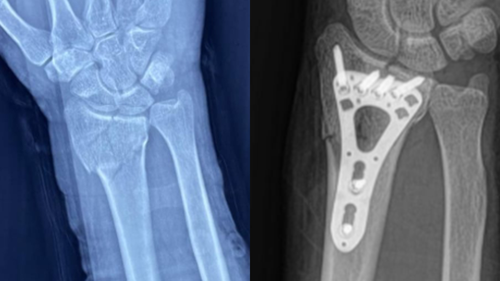 Cirugía exitosa de fractura de radio distal en México con el sistema de placas de bloqueo VA CZMEDITECH