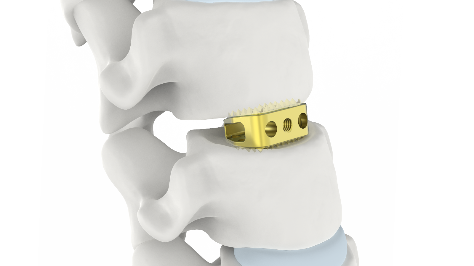 FUSA-CA™ Sistema de fusión intersomática cervical de titanio