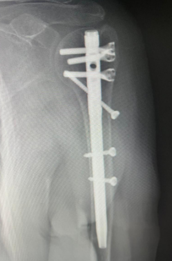 Radiograf&iacute;a posoperatoria despu&eacute;s de la fijaci&oacute;n humeral multilock clavo