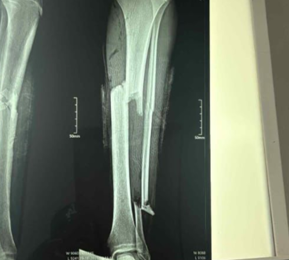 Radiograf&iacute;as preoperatorias pareadas que muestran una fractura tibial parcial. 