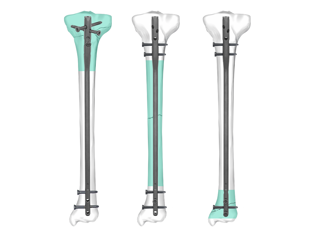 TIVO™ Expert Tibial Clavo sistema de implante
