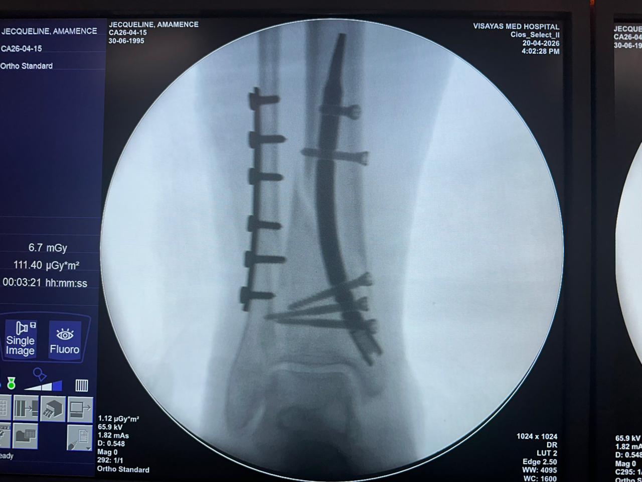 clavo-tibial-distal-fluoroscopia-intraoperatoria-czmeditech (2)