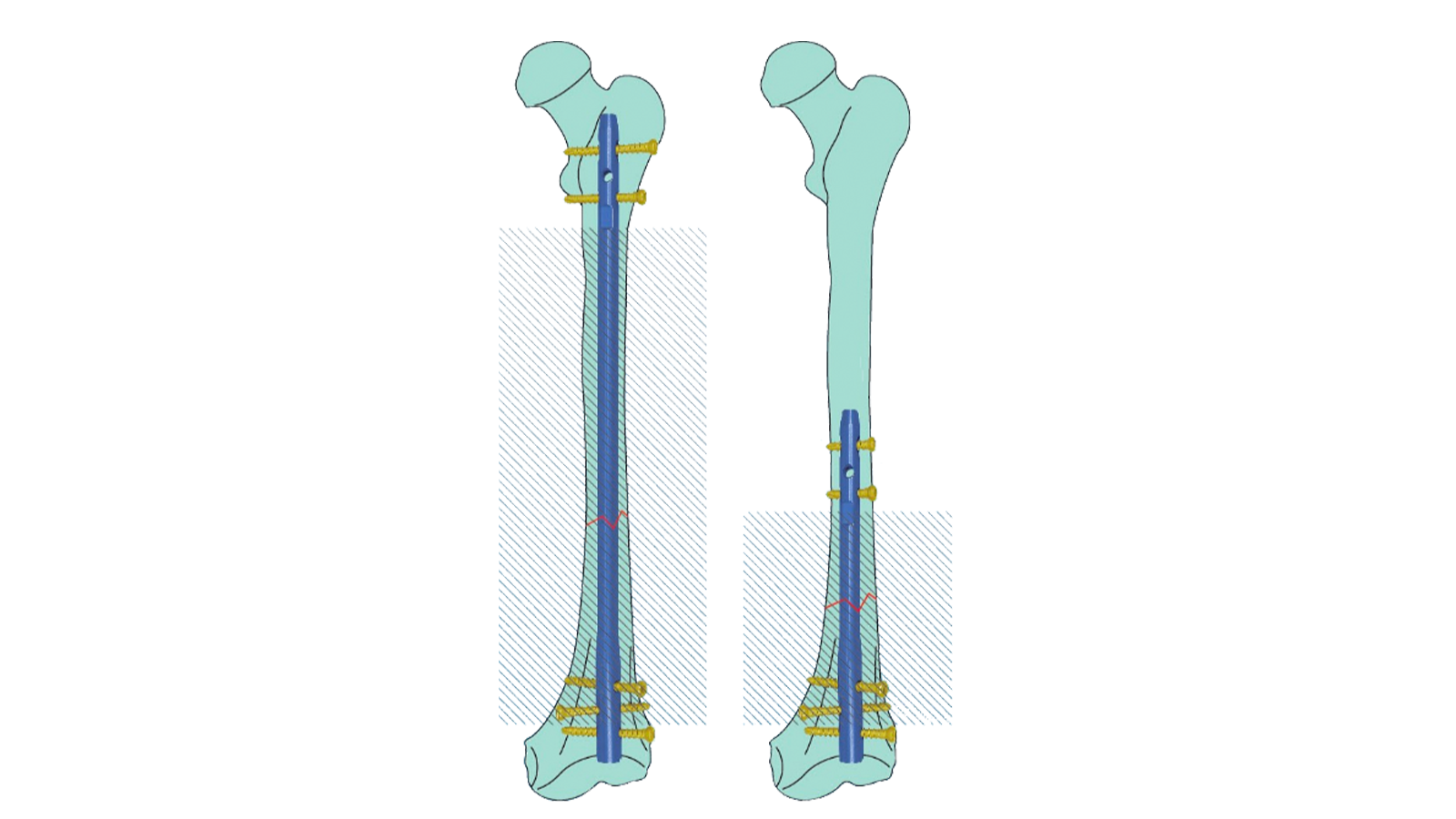 Clavo intramedular femoral retrógrado Expert REXO™