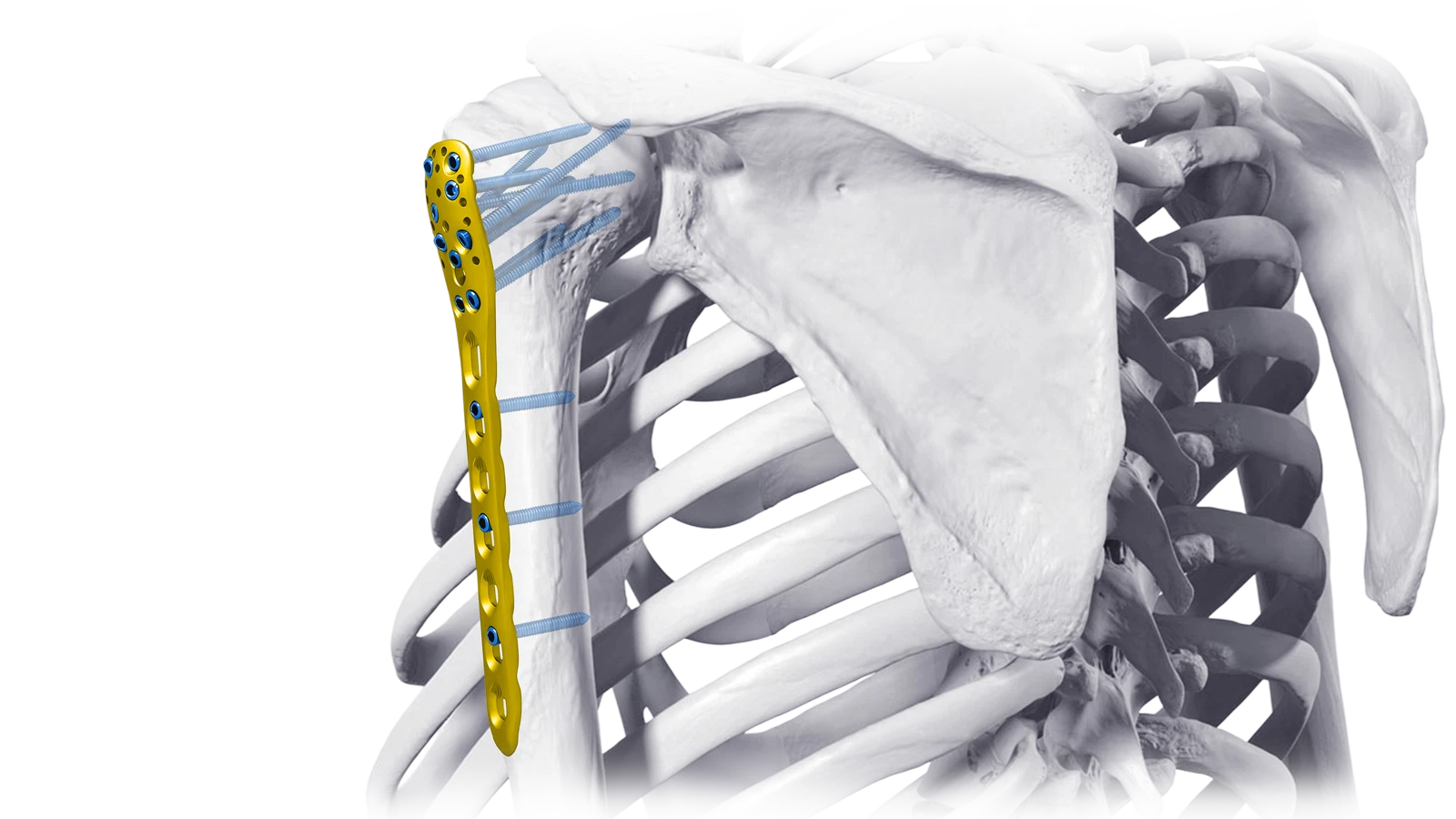 Upper Extremity locking plate system