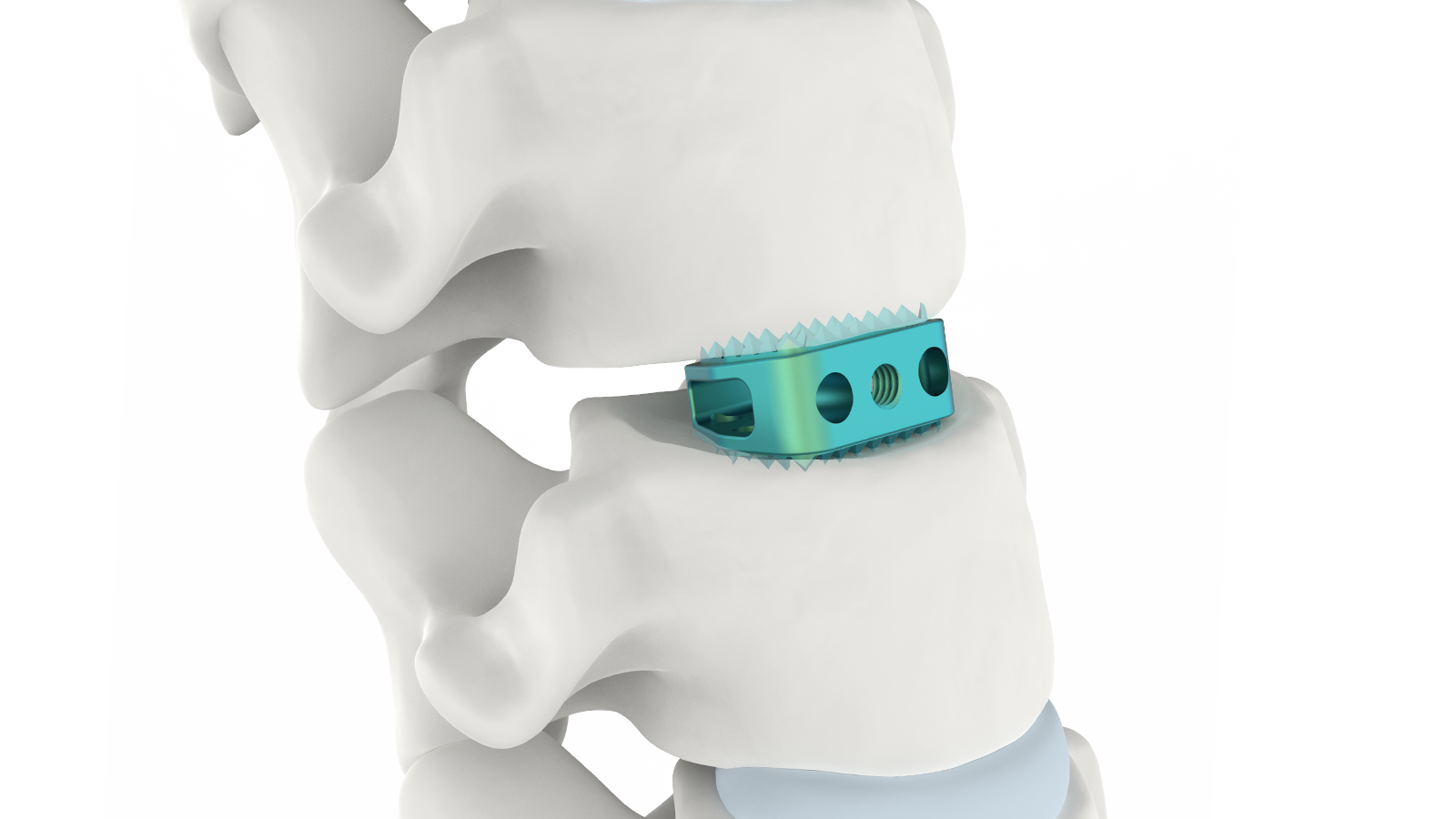FUSA-CW™ Sistema de fusión intersomática cervical de titanio