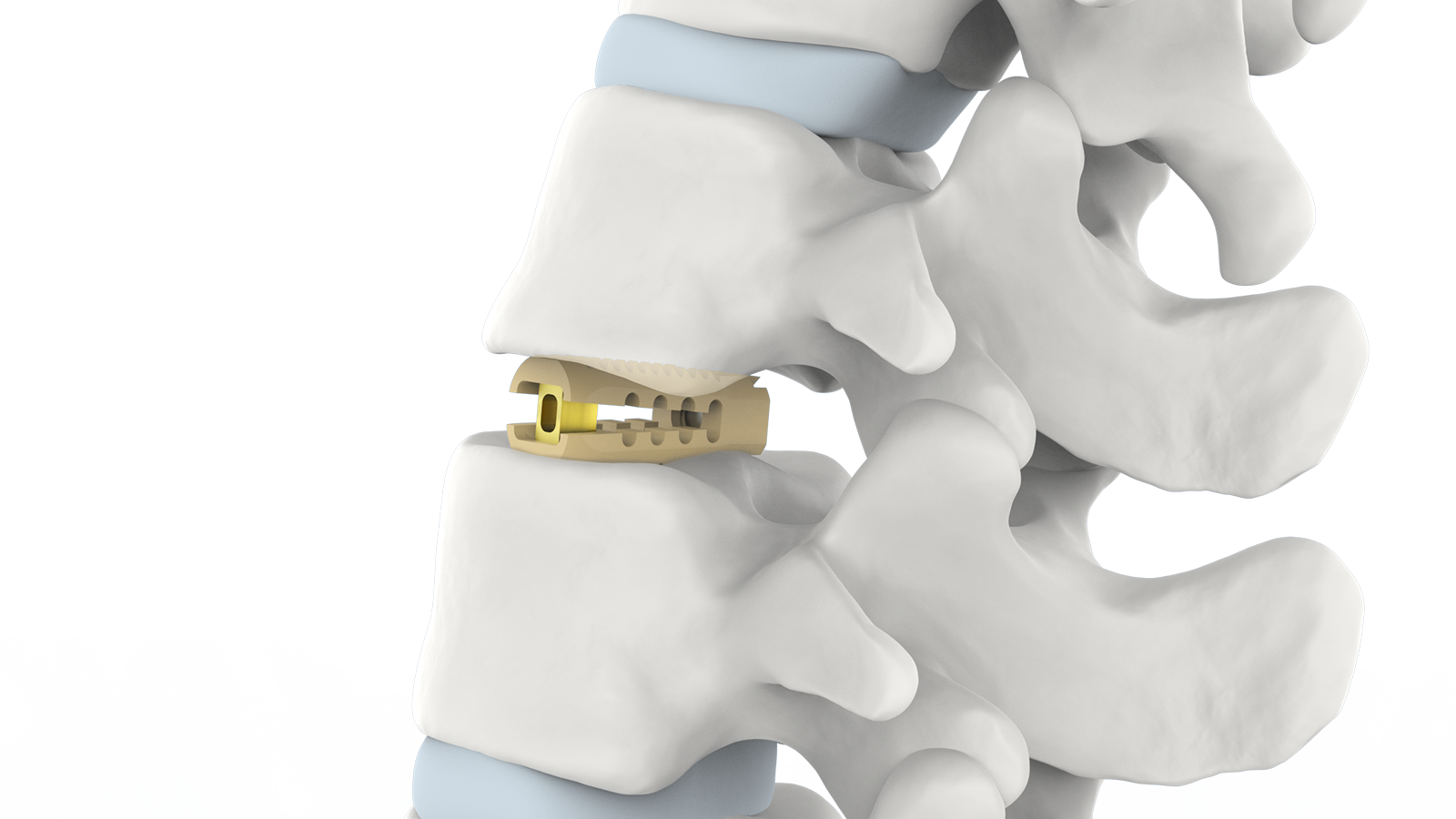 FUSA-RF™ Sistema de fusión intersomática lumbar Rafus de PEEK