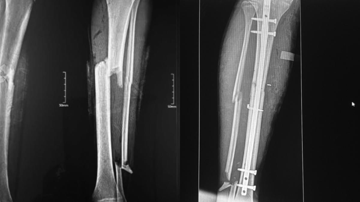 Tratamiento de fractura tibial en México: fijación interna avanzada con clavo tibial Expert y placa de acero — portada del caso clínico