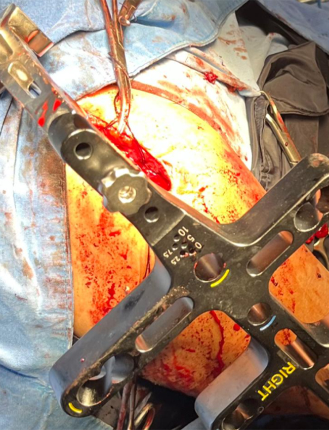 Inserci&oacute;n y fijaci&oacute;n de implantes intraoperatorios.