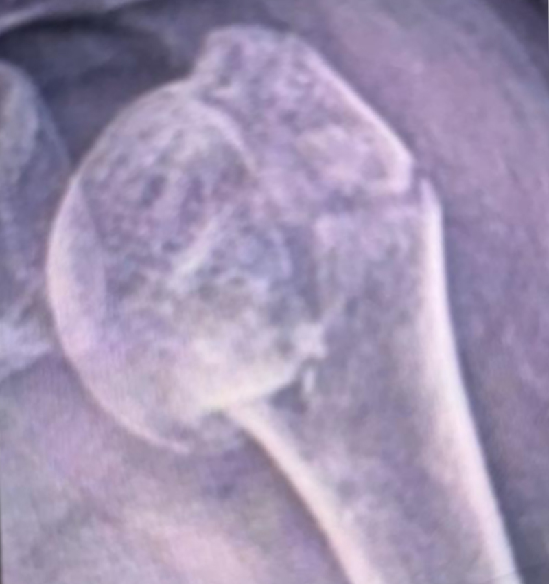 Radiograf&iacute;a preoperatoria que muestra fractura de cabeza humeral