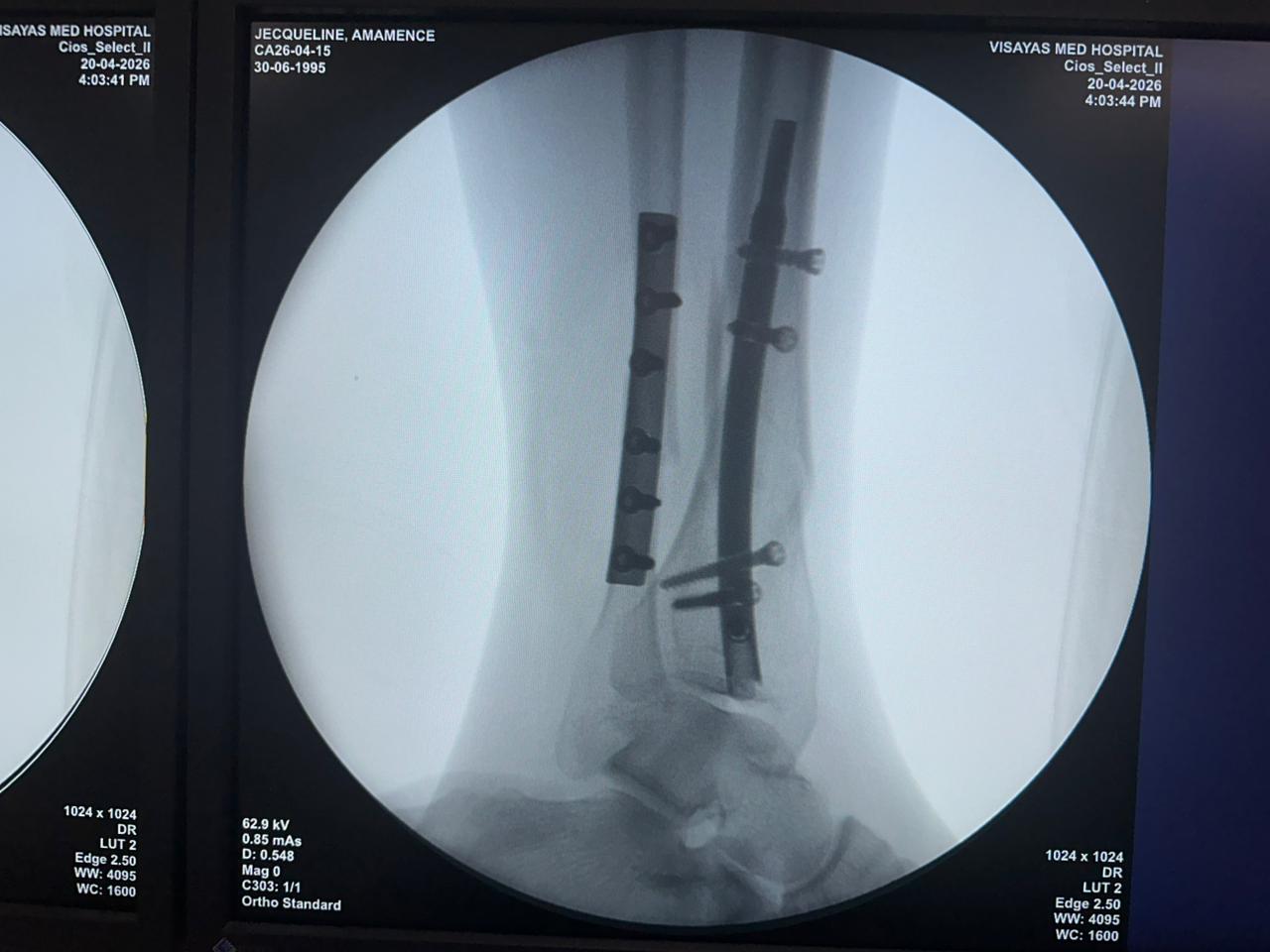 clavo-tibial-distal-fluoroscopia-intraoperatoria-czmeditech (3)