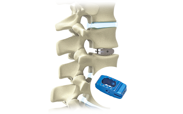 Jaula lumbar PLIF de titanio