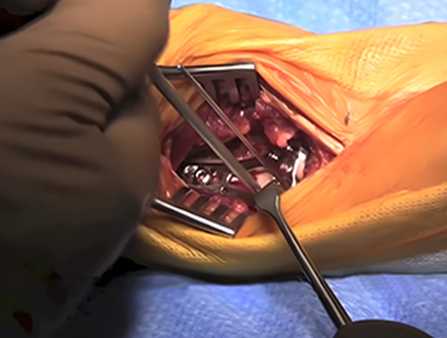 Posicionamiento intraoperatorio de placas y tornillos 