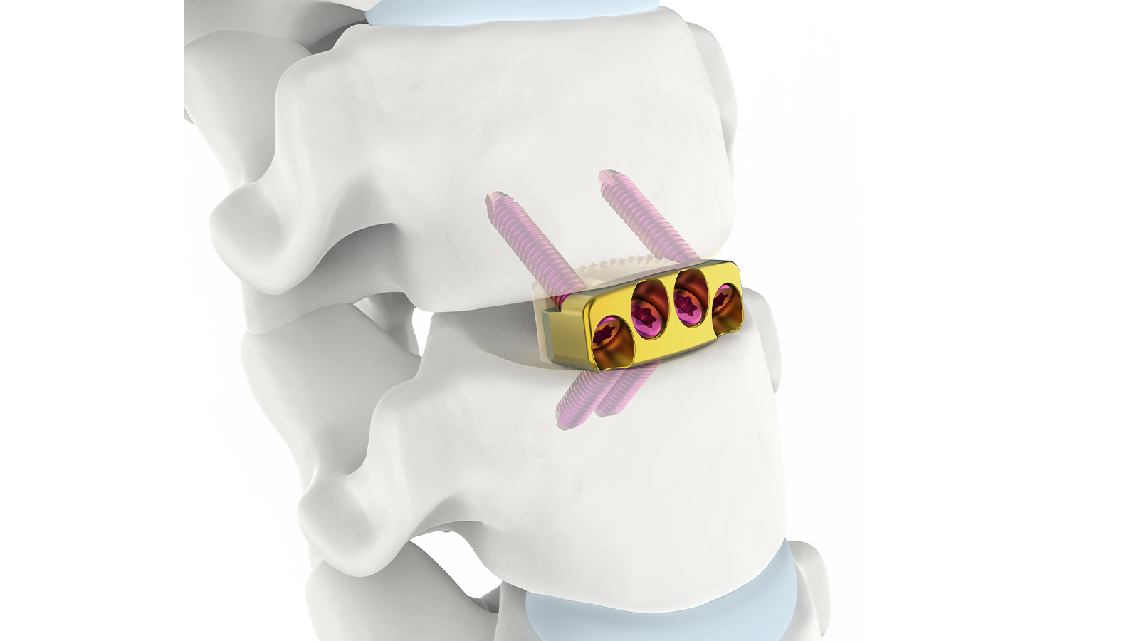 FUSA-C4™ Sistema de fusión intersomática cervical autónomo de PEEK