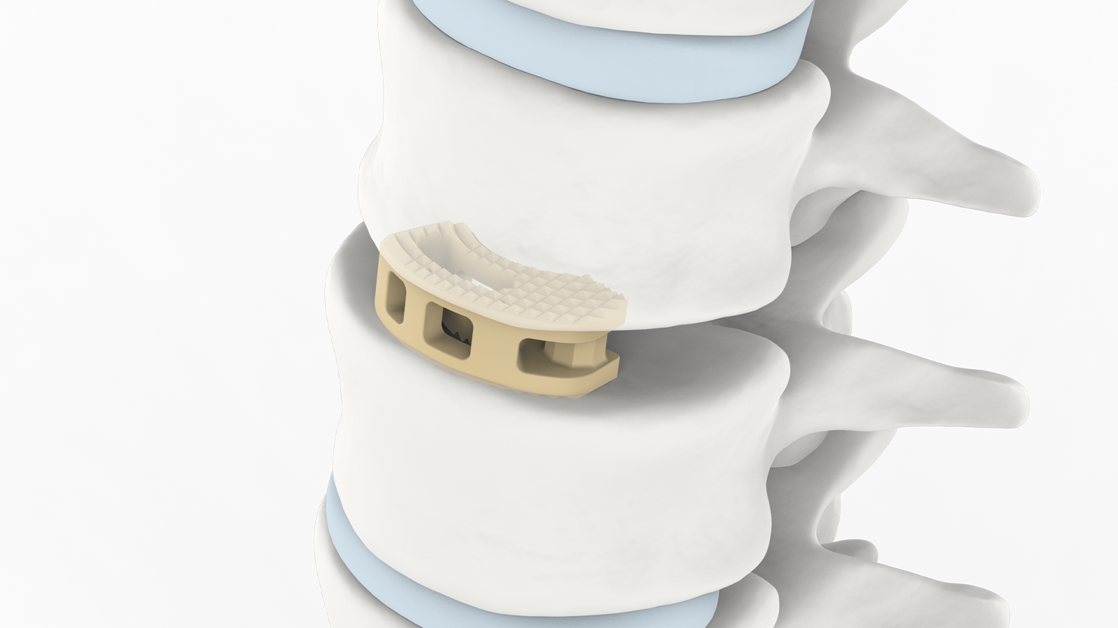 Sistema de fusión intersomática lumbar
