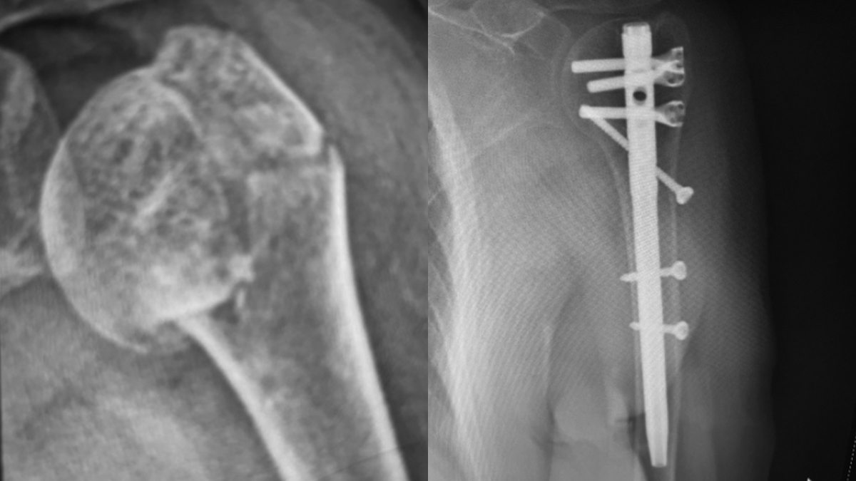 Tratamiento exitoso de una fractura de cabeza humeral en México — portada del caso clínico