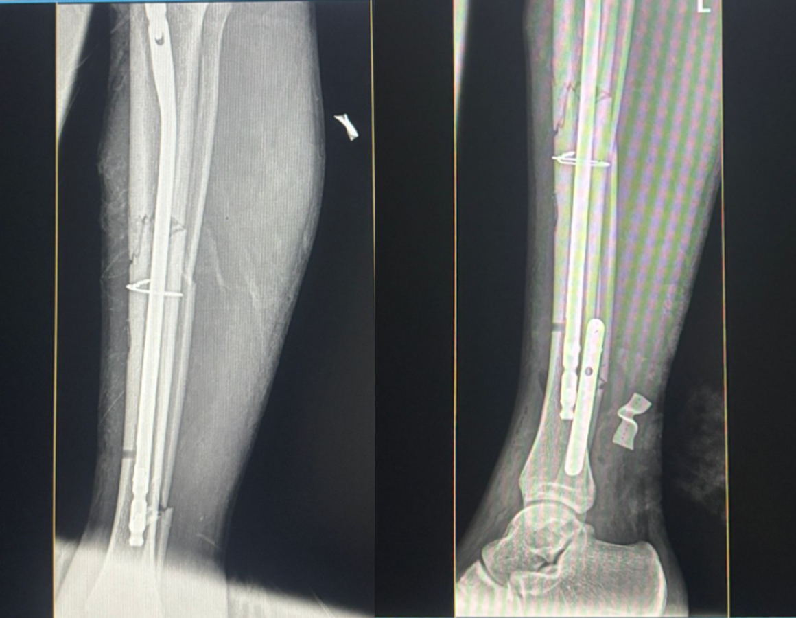 Radiograf&iacute;as postoperatorias pareadas que muestran la fijaci&oacute;n de la placa tibial clavo y circular.