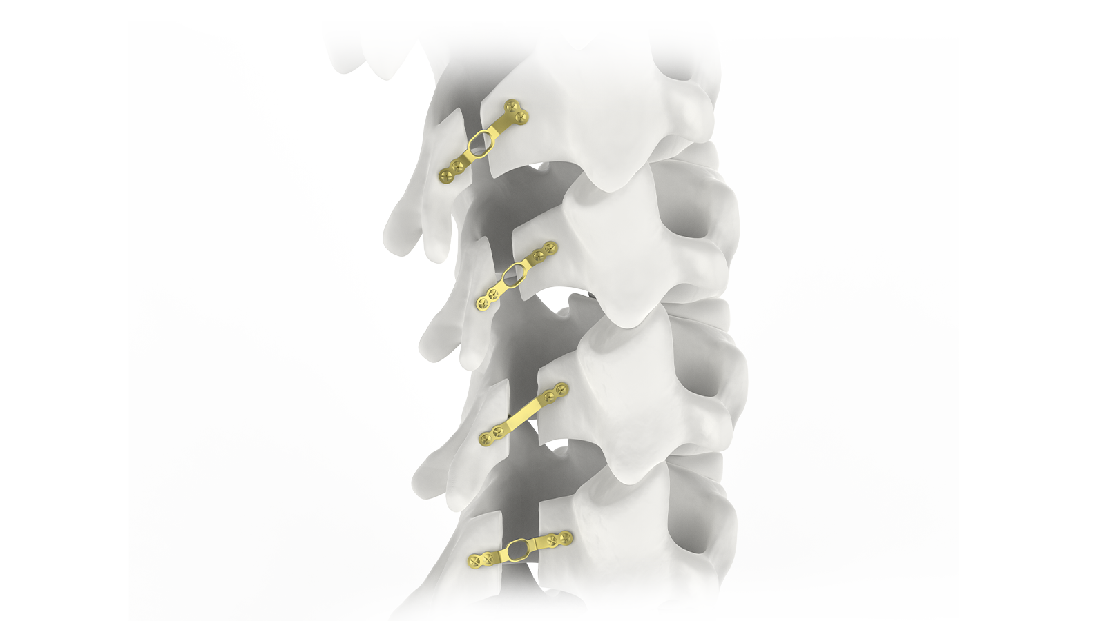 Sistema de laminoplastia