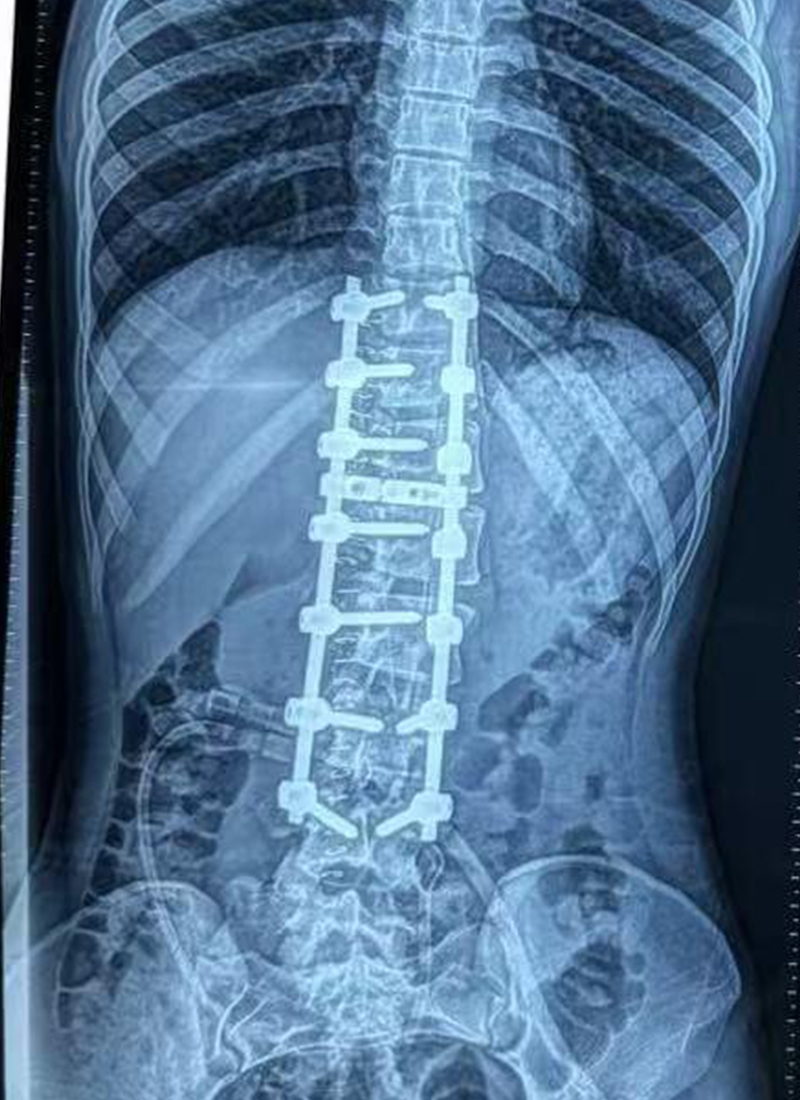 Radiograf&iacute;a AP posoperatoria 