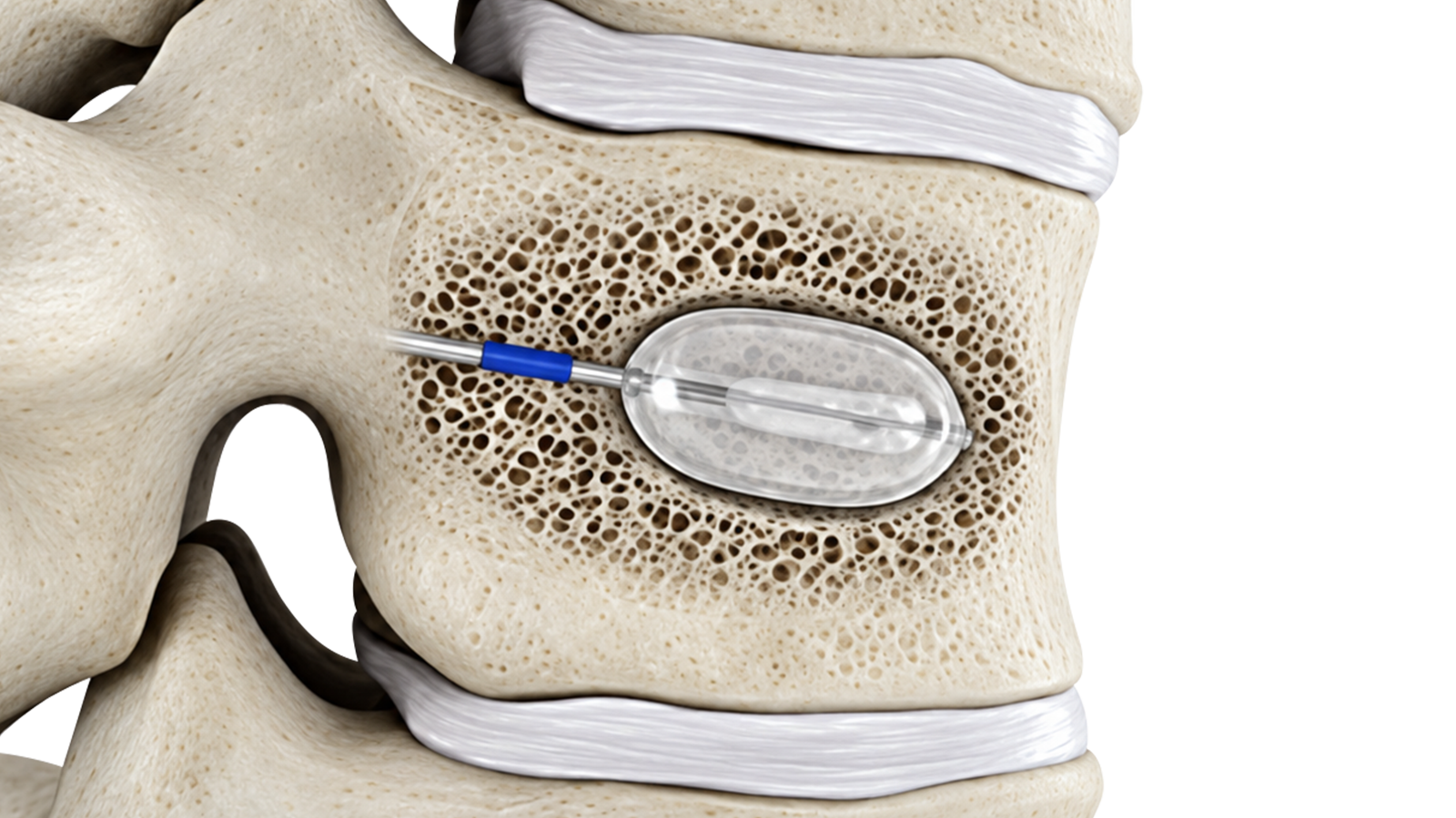 Sistema de aumento vertebral