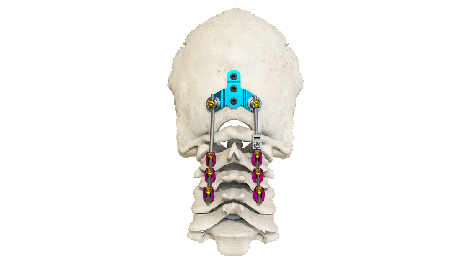 Sistema de fijación cervical