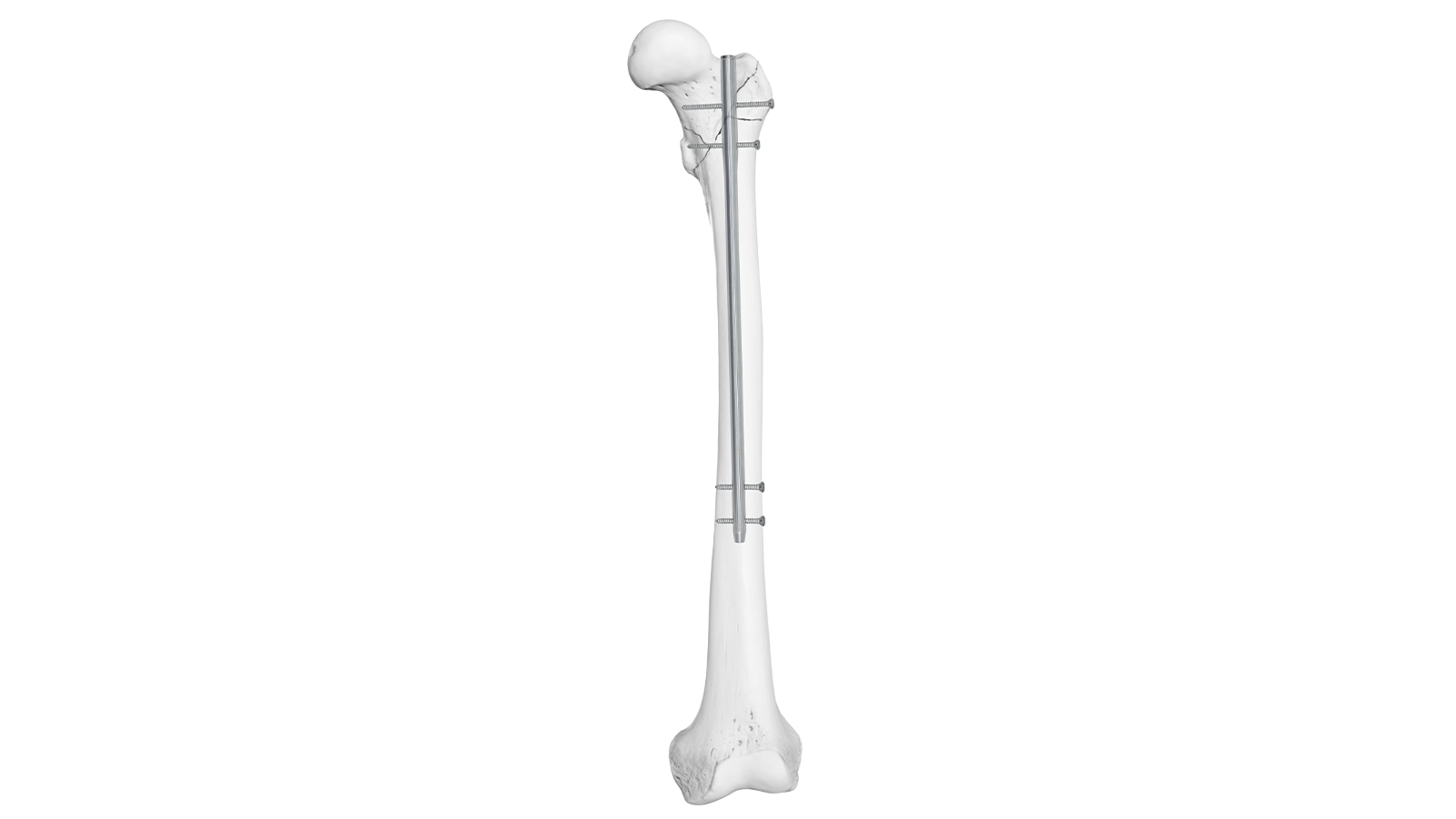 Clavo intramedular femoral ARVO™