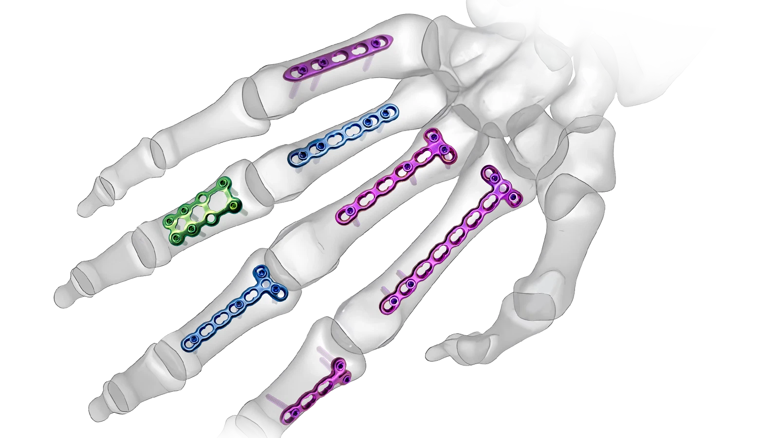 Mini Fragment and Hand locking plate system