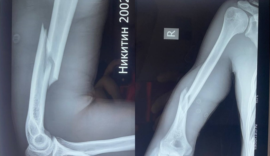 Radiograf&iacute;a preoperatoria de fractura de di&aacute;fisis humeral derecha Radiograf&iacute;a 